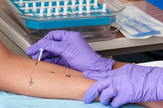 This picture shows a person getting a skin-prick test to measure his or her allergic reactions.