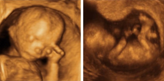 Two images from a 4d ultrasound (click for credit)
